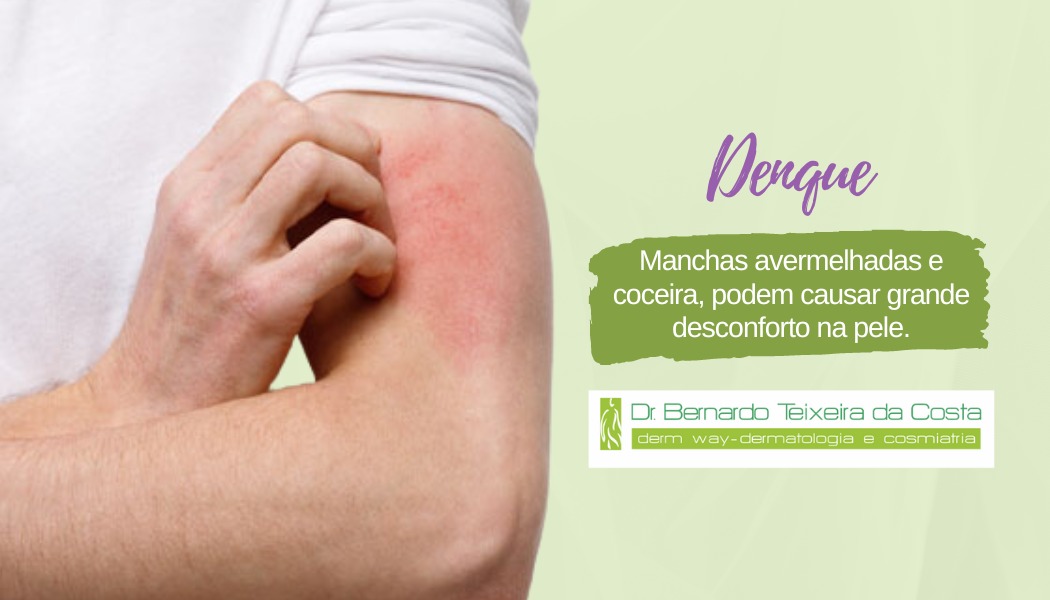 A dengue e os sinais na sua pele!