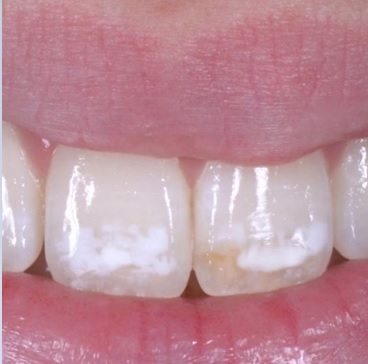 Sobre a fluorose dental e dentes manchados
