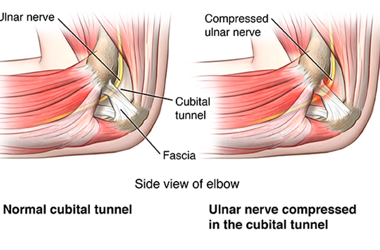 Síndrome do Túnel Cubital