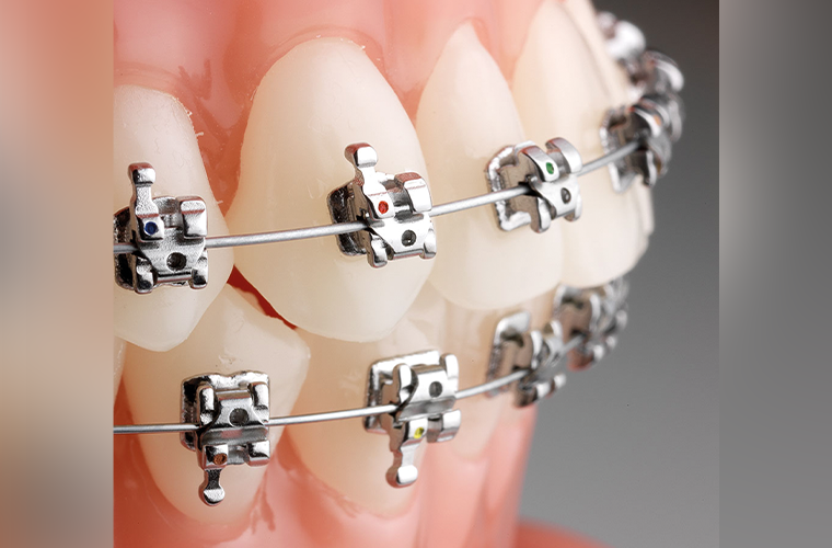 Aparelhos Autoligáveis: Uma revolução na Ortodontia!